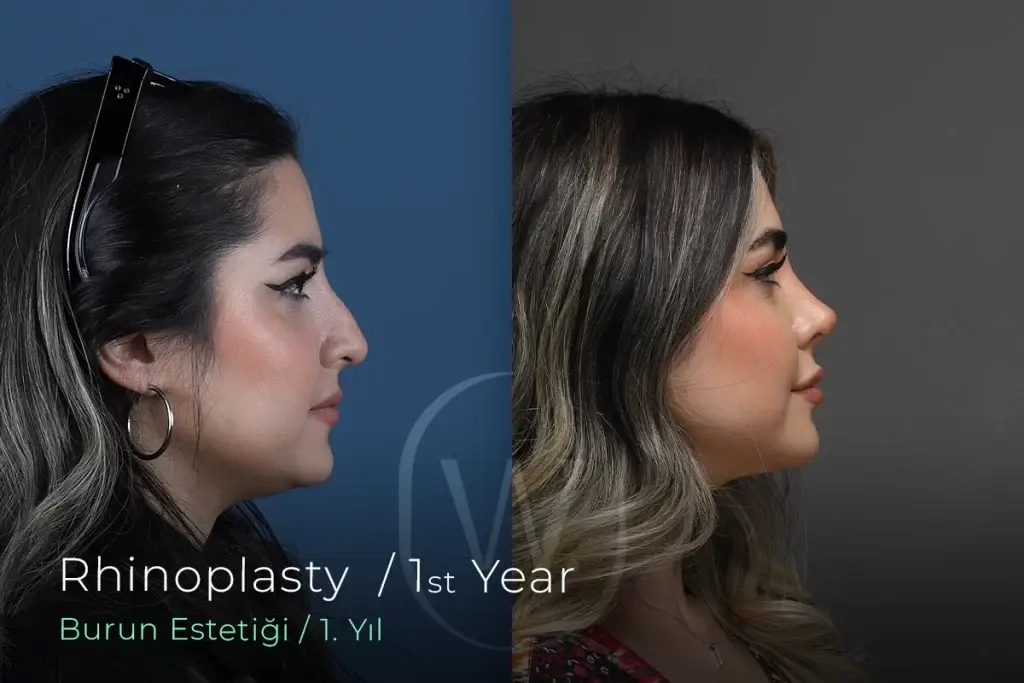 Ultrasonic Rhinoplasty Before-After