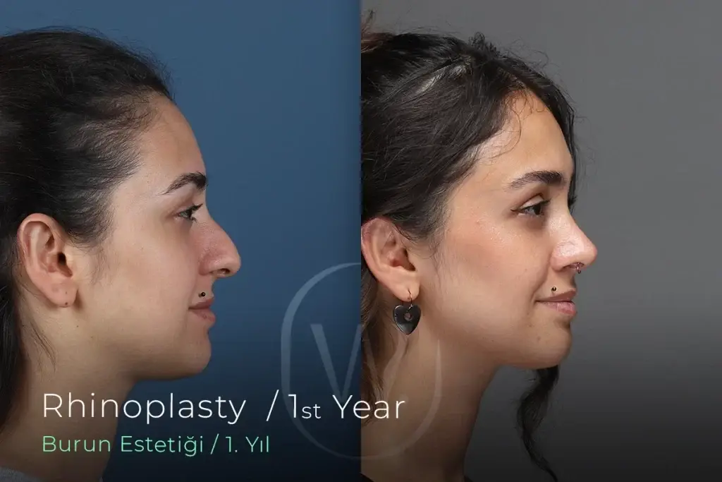 Ultrasonic Rhinoplasty Before-After