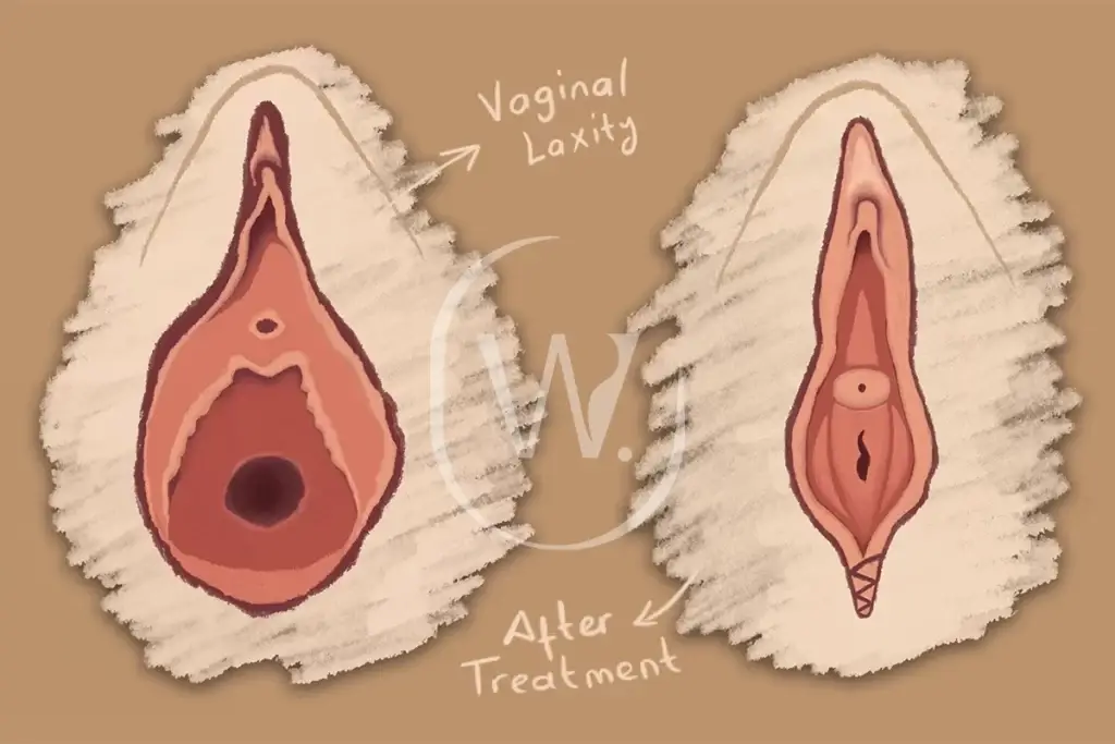 Comparison of vaginal laxity before and after vaginoplasty, highlighting the transformative effects of vaginoplasty after childbirth in restoring structure and function.